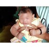 Em bé Việt Nam đầu tiên nghi bị dị tật đầu nhỏ do virus Zika